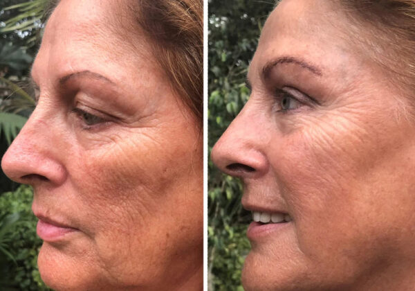 Restore Serum Obnovující sérum PŘED A PO (1)